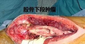 做完手术癌细胞会迅速扩散吗(癌细胞转移和扩散)