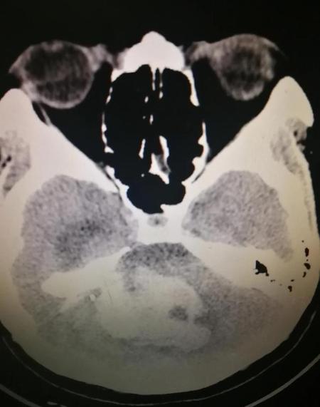 颅内出血严重吗(摔倒颅内出血严重吗)