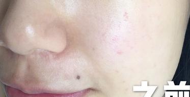 脸上红血丝修复用什么护肤品你知道吗?(脸上的东西)