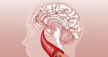 血栓和脑梗是一个病吗(脑血栓脑梗塞什么区别)