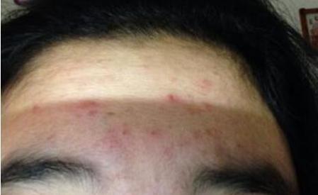 角质会引起痘痘吗(毛囊角化异常引起的痘痘)