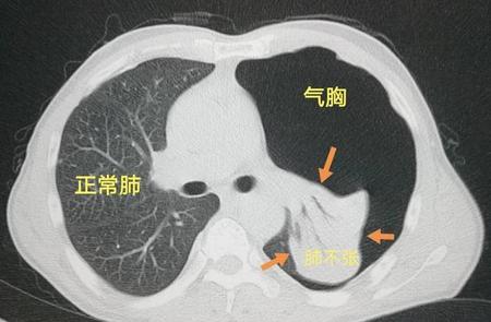 肺不张多久肺会坏死(肺泡坏死是什么病)