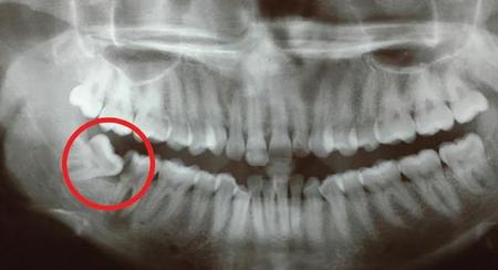 为什么会长智齿?是不是一定要拔掉?