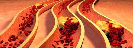 血管完全堵塞能打通不(小腿静脉丛血栓形成)