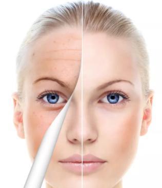 光子嫩肤是什么原理?对皮肤有害吗(光子嫩肤不同波长怎么选)