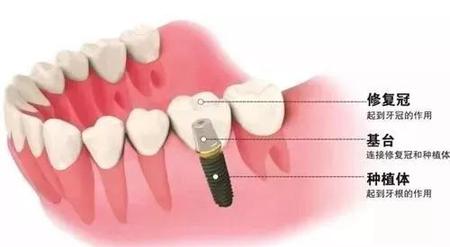 种植牙的种植体有哪些(种植牙的种植体有几种)