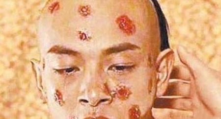 人类怎么消灭天花的(hiv疫苗研发进展)