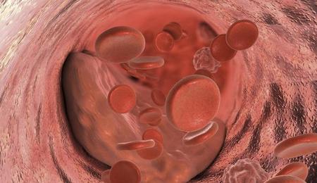 脑血栓如何检查出来(如何检查自己有没有脑血栓)