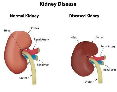 肾衰竭有哪些症状