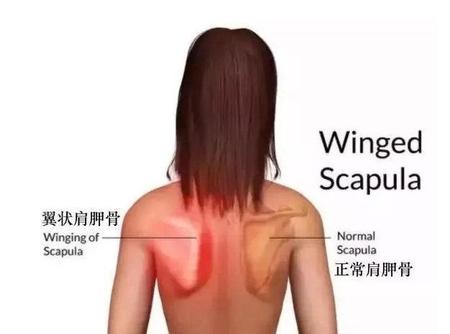 翼状肩胛和蝴蝶背(扩胸运动可以拉伸胸肌吗)