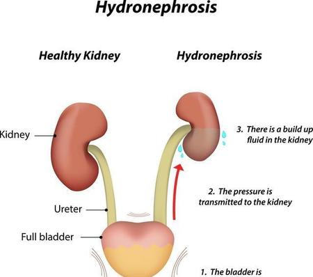 iga肾病到底是什么病(链球菌感染后肾小球肾炎与iga肾病)