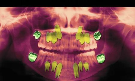 智齿非要拔掉吗(拔智齿后出现炎症的表现)