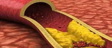 血脂高又不能吃他汀类药(高血脂的用药)