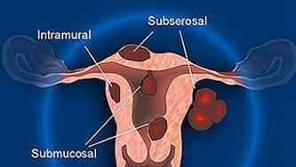子宫肌瘤是长在哪里的图片(子宫肌瘤在什么位置图)