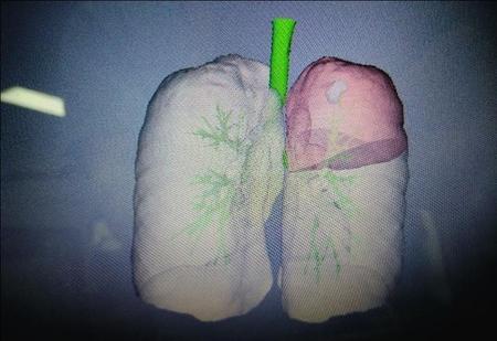 肺为什么不能移植(肺移植可以治疗肺癌吗)
