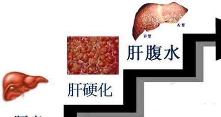 早期肝硬化腹水能治好吗