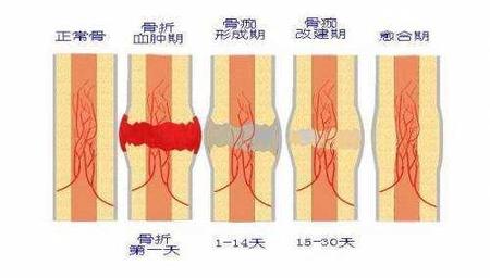 骨折后骨小梁稀疏有什么后果(骨质密度减低骨小梁稀疏)