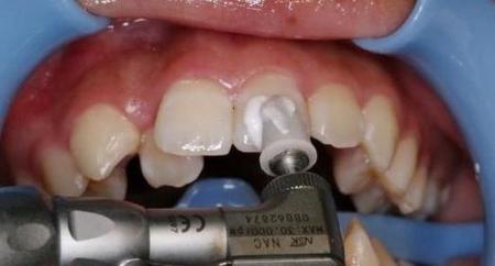 洗牙一次多久(洗一次牙结石)