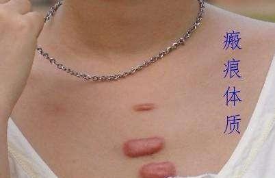 微创手术如何去除瘢痕